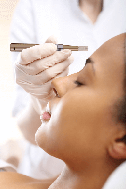 microneedling